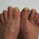 NutriNail® – El único adhesivo antifúngico que elimina los hongos al instante