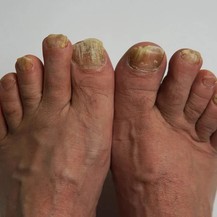 NutriNail® – El único adhesivo antifúngico que elimina los hongos al instante